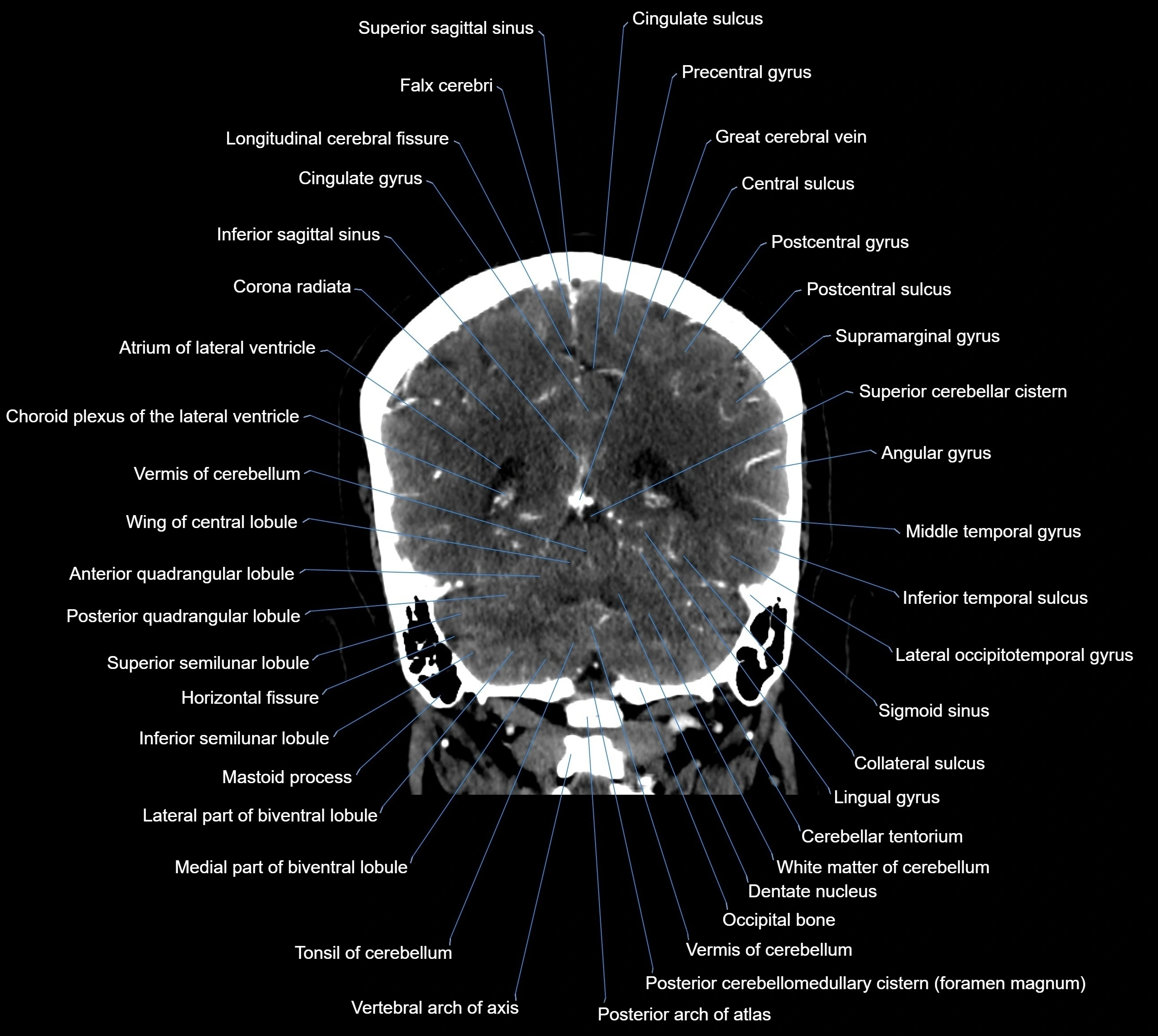 CT Brain coronal cross sectional radiology anatomy image  -img-00001-033.webp